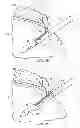 Fig. 06 - Restricted wedge suture anchor and method for soft tissue repair