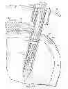 Fig. 08 - Restricted wedge suture anchor and method for soft tissue repair