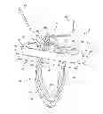 Fig. 01 - Tissue graft anchoring
