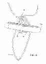 Fig. 08 - Tissue graft anchoring