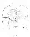 Fig. 02 - Techniques for mitigating motion artifacts from implantable physiological sensors