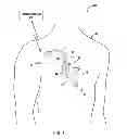 Fig. 02 - Adaptive cardiac resynchronization therapy