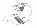 Fig. 01 - Electrode band system and methods of using the system to treat obesity