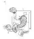 Fig. 02 - Electrode band system and methods of using the system to treat obesity