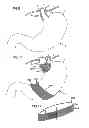 Fig. 10 - Electrode band system and methods of using the system to treat obesity