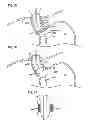 Fig. 12 - Electrode band system and methods of using the system to treat obesity