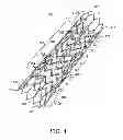 Fig. 02 - Stent