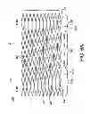 Fig. 09 - Stent
