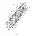 Fig. 02 - Stent