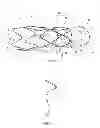 Fig. 02 - Implantable medical device with fenestration and radiopaque marker coils on stents