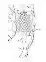 Fig. 01 - Inversion delivery device and method for a prosthesis