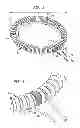 Fig. 02 - Adjustment suture markers for adjustable annuloplasty ring