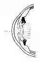 Fig. 01 - Accommodating intraocular lens