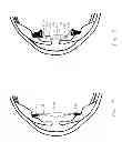 Fig. 05 - Accommodating intraocular lens