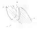 Fig. 01 - Vertebral facet joint prosthesis and method of fixation