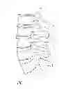 Fig. 02 - Vertebral facet joint prosthesis and method of fixation