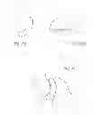 Fig. 08 - Vertebral facet joint prosthesis and method of fixation