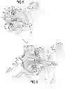 Fig. 08 - Reverse shoulder prosthetic