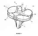 Fig. 04 - Prosthetic joint