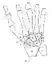 Fig. 02 - Prosthesis for the basal joint of the thumb
