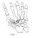 Fig. 09 - Prosthesis for the basal joint of the thumb