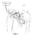 Fig. 02 - Pacemaker event queue to control device processor operating power