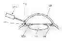 Fig. 01 - Near Quadrant Glaucoma Treatment Method