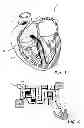 Fig. 02 - Device, A Kit And A Method For Treatment Of Disorders In The Heart Rhythm Regulation System
