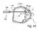 Fig. 22 - Device, A Kit And A Method For Treatment Of Disorders In The Heart Rhythm Regulation System