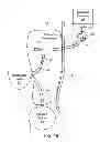 Fig. 03 - Systems and methods for treating chronic liver failure based on peritoneal dialysis