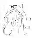 Fig. 02 - Method and apparatus for repairing a mitral valve