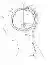 Fig. 01 - Cam lock burr hole plug for securing stimulation lead