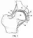 Fig. 02 - JOINT AUGMENTATION IMPLANT AND APPLICATIONS THEREOF