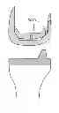Fig. 01 - PATIENT-ADAPTED AND IMPROVED ARTICULAR IMPLANTS, DESIGNS AND RELATED GUIDE TOOLS