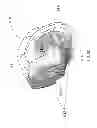 Fig. 13 - PATIENT-ADAPTED AND IMPROVED ARTICULAR IMPLANTS, DESIGNS AND RELATED GUIDE TOOLS