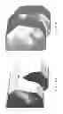 Fig. 141 - PATIENT-ADAPTED AND IMPROVED ARTICULAR IMPLANTS, DESIGNS AND RELATED GUIDE TOOLS