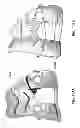 Fig. 147 - PATIENT-ADAPTED AND IMPROVED ARTICULAR IMPLANTS, DESIGNS AND RELATED GUIDE TOOLS