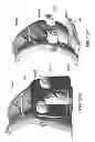 Fig. 149 - PATIENT-ADAPTED AND IMPROVED ARTICULAR IMPLANTS, DESIGNS AND RELATED GUIDE TOOLS
