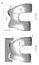 Fig. 152 - PATIENT-ADAPTED AND IMPROVED ARTICULAR IMPLANTS, DESIGNS AND RELATED GUIDE TOOLS