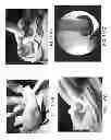 Fig. 159 - PATIENT-ADAPTED AND IMPROVED ARTICULAR IMPLANTS, DESIGNS AND RELATED GUIDE TOOLS