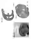 Fig. 167 - PATIENT-ADAPTED AND IMPROVED ARTICULAR IMPLANTS, DESIGNS AND RELATED GUIDE TOOLS