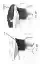 Fig. 174 - PATIENT-ADAPTED AND IMPROVED ARTICULAR IMPLANTS, DESIGNS AND RELATED GUIDE TOOLS