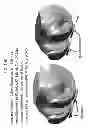 Fig. 187 - PATIENT-ADAPTED AND IMPROVED ARTICULAR IMPLANTS, DESIGNS AND RELATED GUIDE TOOLS