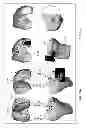 Fig. 19 - PATIENT-ADAPTED AND IMPROVED ARTICULAR IMPLANTS, DESIGNS AND RELATED GUIDE TOOLS