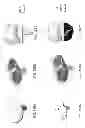 Fig. 200 - PATIENT-ADAPTED AND IMPROVED ARTICULAR IMPLANTS, DESIGNS AND RELATED GUIDE TOOLS