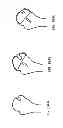 Fig. 237 - PATIENT-ADAPTED AND IMPROVED ARTICULAR IMPLANTS, DESIGNS AND RELATED GUIDE TOOLS