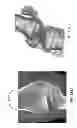 Fig. 241 - PATIENT-ADAPTED AND IMPROVED ARTICULAR IMPLANTS, DESIGNS AND RELATED GUIDE TOOLS