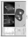 Fig. 252 - PATIENT-ADAPTED AND IMPROVED ARTICULAR IMPLANTS, DESIGNS AND RELATED GUIDE TOOLS