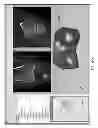 Fig. 253 - PATIENT-ADAPTED AND IMPROVED ARTICULAR IMPLANTS, DESIGNS AND RELATED GUIDE TOOLS