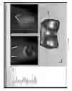 Fig. 255 - PATIENT-ADAPTED AND IMPROVED ARTICULAR IMPLANTS, DESIGNS AND RELATED GUIDE TOOLS